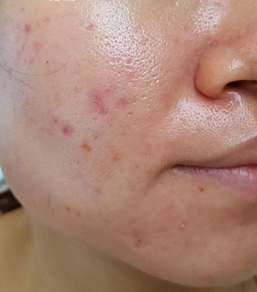 Biểu hiện da dầu nhờn cách chăm sóc da dầu