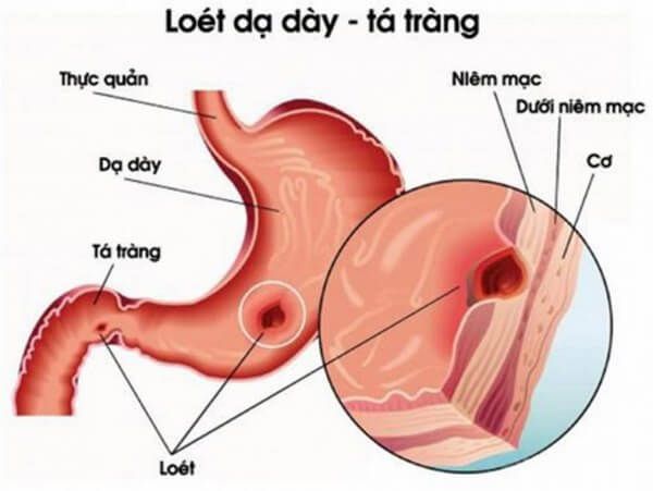 Omevin IV - Điều trị viêm loét dạ dày tá tràng